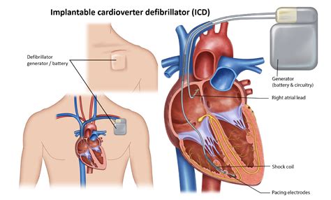 Defibrilllator Implant - Melbourne Heart Group