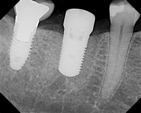 Dental Implant Xray