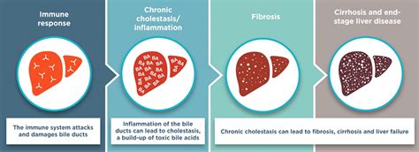 Primary Biliary Cholangitis (formerly Primary Biliary Cirrhosis) - Canadian Liver Foundation