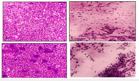 Microphotograph of FNAC lymph node showing NHL in smears fixed with 95% ...