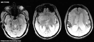 Dr Balaji Anvekar FRCR: Superficial Siderosis MRI Brain