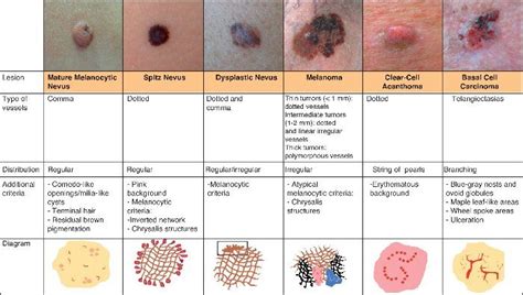 Squamous cell, Squamous cell carcinoma, Basal cell