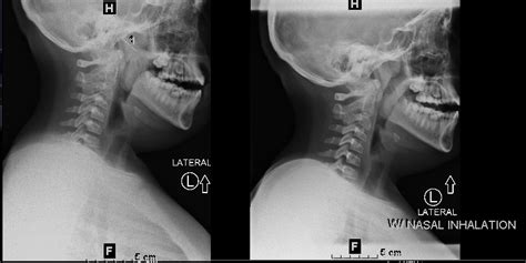 X-ray Soft Tissue Neck - Chattanooga Imaging