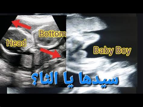 Live baby Boy/Girl Cephalic &Breech Presentation in pregnancy | Breech birth position | frank ...