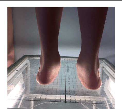 Treatment of severe planovalgus foot deformity in a child | Semantic Scholar