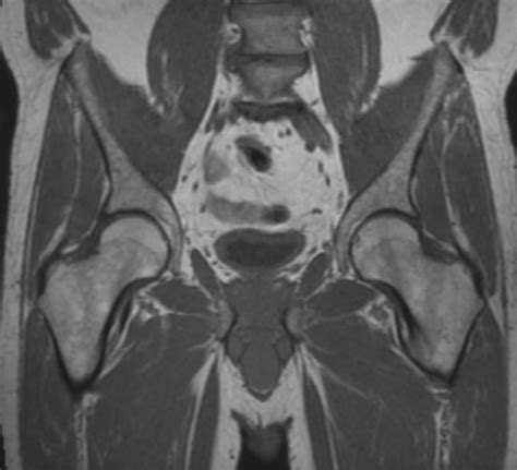 MRI Pelvis (Male) - Mediphany