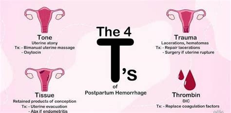 POSTPARTUM HEMORRHAGE (PPH) Part 2 – THISDAYLIVE