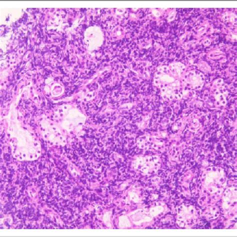 (PDF) Nasal Maggot Infection in a Patient With Nasal Non-Hodgkin’s Lymphoma