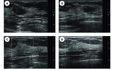 A 26 year-old female with fibroadenoma on ultrasound image. (A) A... | Download Scientific Diagram