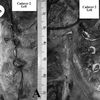 (PDF) The Anatomy of the Lateral Branches of the Sacral Dorsal Rami: Implications for ...