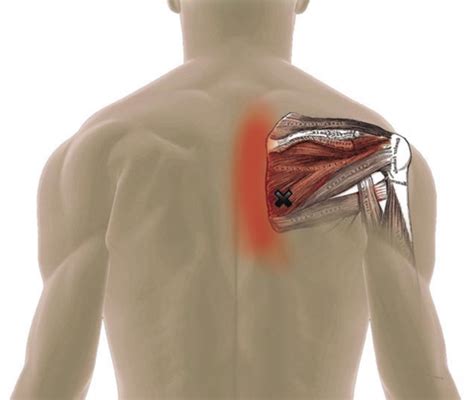 Assisted Stretching for Trigger Points - Infraspinatus | Trigger points, Shoulder stretching ...