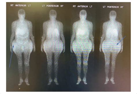 Gallium scan revealing increased areas of uptake due to granulomatous... | Download Scientific ...