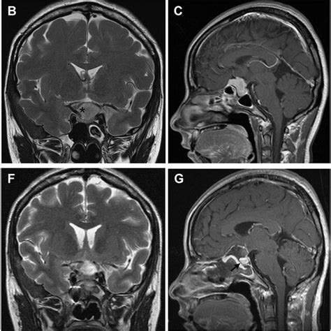 Tuberculum sellae meningioma (WHO grade I). (A–D) Preoperative MRI ...