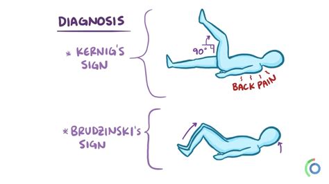 Signs of meningeal irritation | Patologia