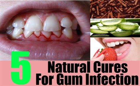 5 Natural Cures For Gum Infection – Natural Home Remedies & Supplements