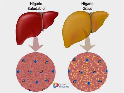 TU SALUD: Los síntomas del hígado graso y cómo curarlo