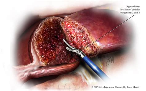 Liver Sectionectomy Illustrations, & Medical Surgical Illustrations