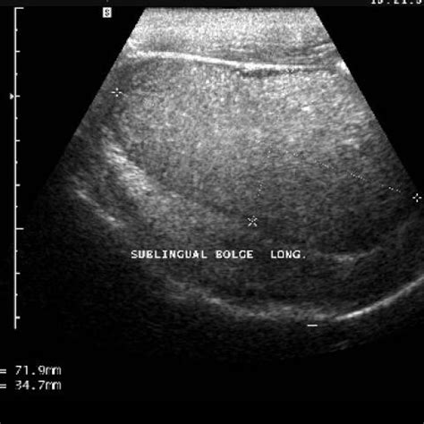 Dermoid Cyst Scalp Ultrasound – SCALP