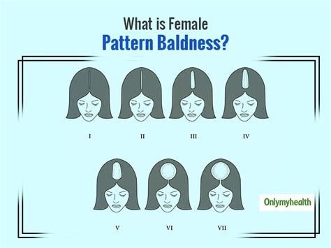 Female Pattern Hair Loss: Symptoms, Stages And Treatment | OnlyMyHealth