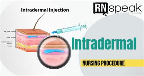 Intradermal Injection Nursing Procedure