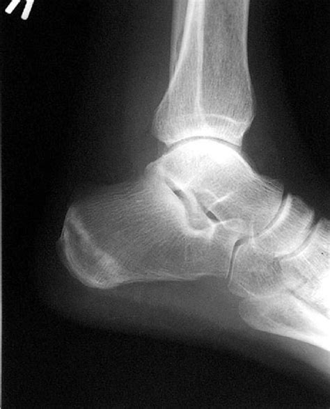 Stress fracture x ray - wikidoc