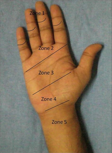 flexor tendon zones of the hand - Google Search | Hand Therapy (OT) | Pinterest | Google search ...