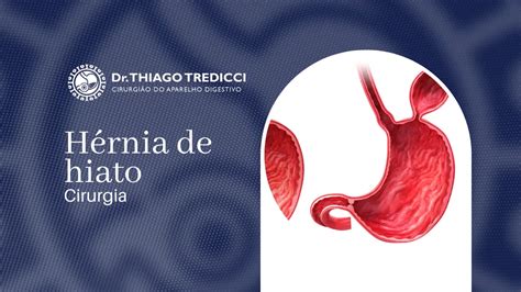 Cirurgia de Hérnia de Hiato: Entenda todo o Procedimento