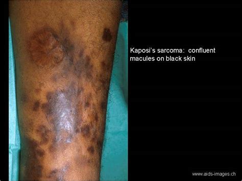 Kaposi Sarcoma Lesions Like