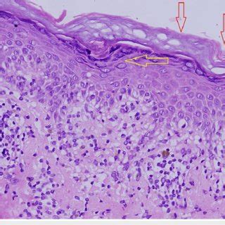 Dermatoscopy examination of the lesions showing Wickham striae clearly ...