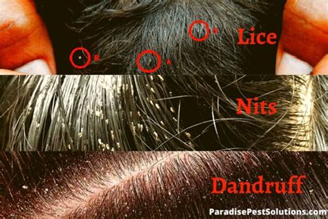 Lice vs Dandruff: How To Tell The Difference?