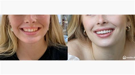 Porcelain Veneers Philadelphia PA, 46% OFF