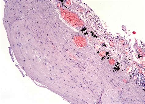 Parietal Pleura Histology