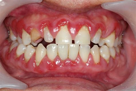 Swollen Gums And Diet — Dr. Scott Solomons