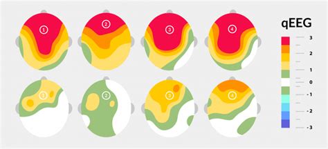 qEEG Brain Mapping Neurofeedback Los Angeles | NeuroZone