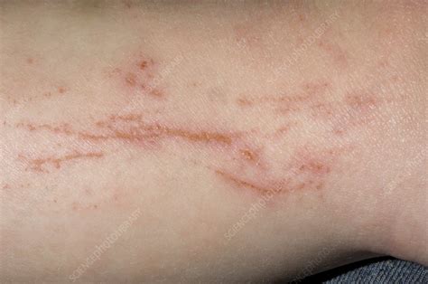 Atopic eczema with scratch marks - Stock Image - C002/9569 - Science Photo Library