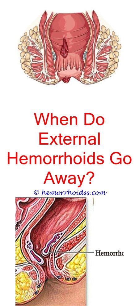 Pin on Internal Hemorrhoids