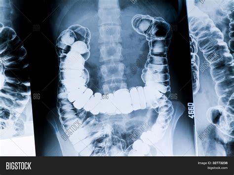 Radiography Intestine Image & Photo (Free Trial) | Bigstock