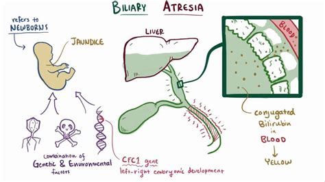 Choanal Atresia: What Is It, Causes, Signs and Symptoms, Treatment, and More | Osmosis