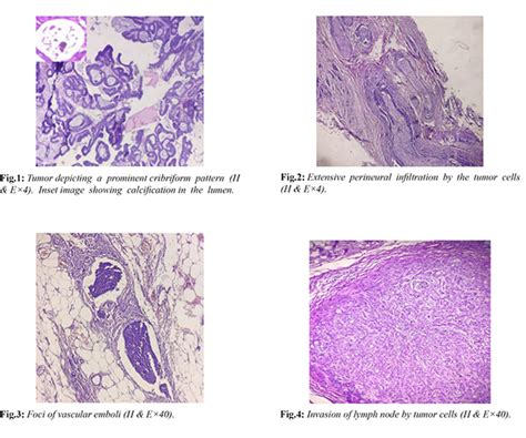 Unusual case of Invasive Cribriform Carcinoma of Breast (ICC)