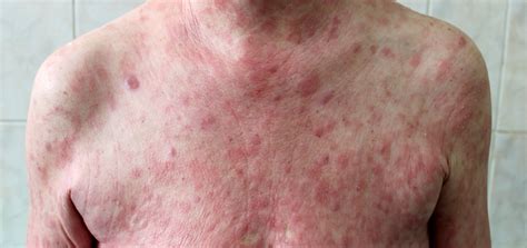 Mycosis Fungoides | Dermatology and Skin Health - Dr. Mendese