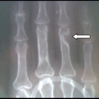 Osteitis fibrosa cystica of the right humerus (arrow) and old fracture ...