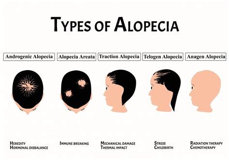 #5-7. Alopecia Areata | D&PS