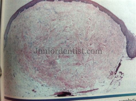 Oral/Dental Fibroma - Clinical, Histological Features and Treatment