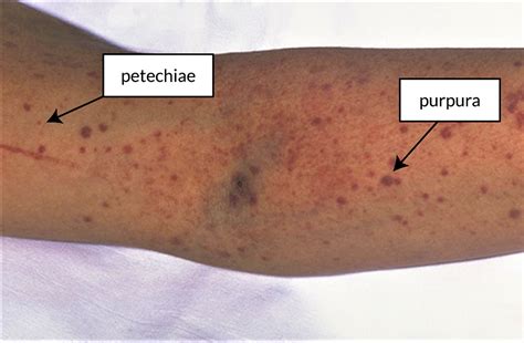 Disseminated intravascular coagulation causes, signs, symptoms ...