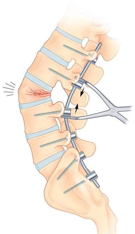 Pedicle Subtraction Osteotomy | Neupsy Key