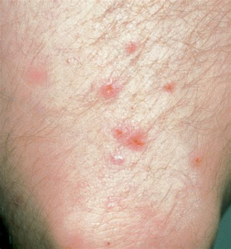 Dermatitis Herpetiformis | Diseases & Conditions | 5MinuteConsult