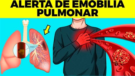 Embolia Pulmonar Síntomas Prevención Y Tratamiento - Mobile Legends