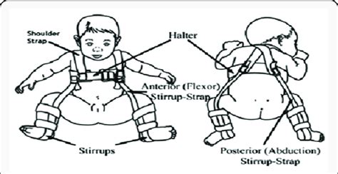 Pavlik harness device. | Download Scientific Diagram