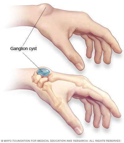 Ganglion Cysts Palos Hills, Mokena and Chicago