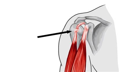 Long Head of Biceps Rupture - Symptoms, Causes and Treatment.